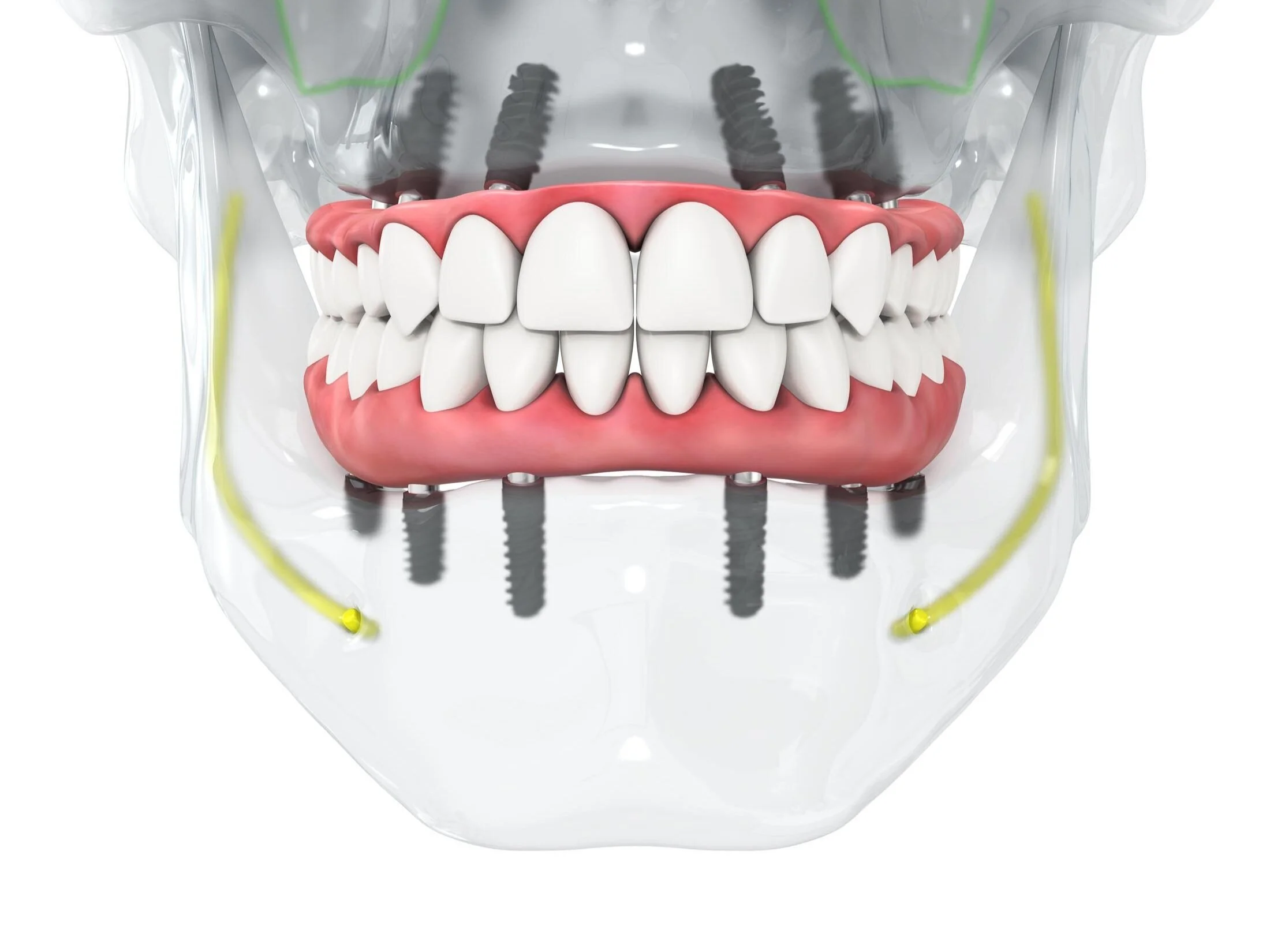 depiction of hybrid teeth implants in the jaw