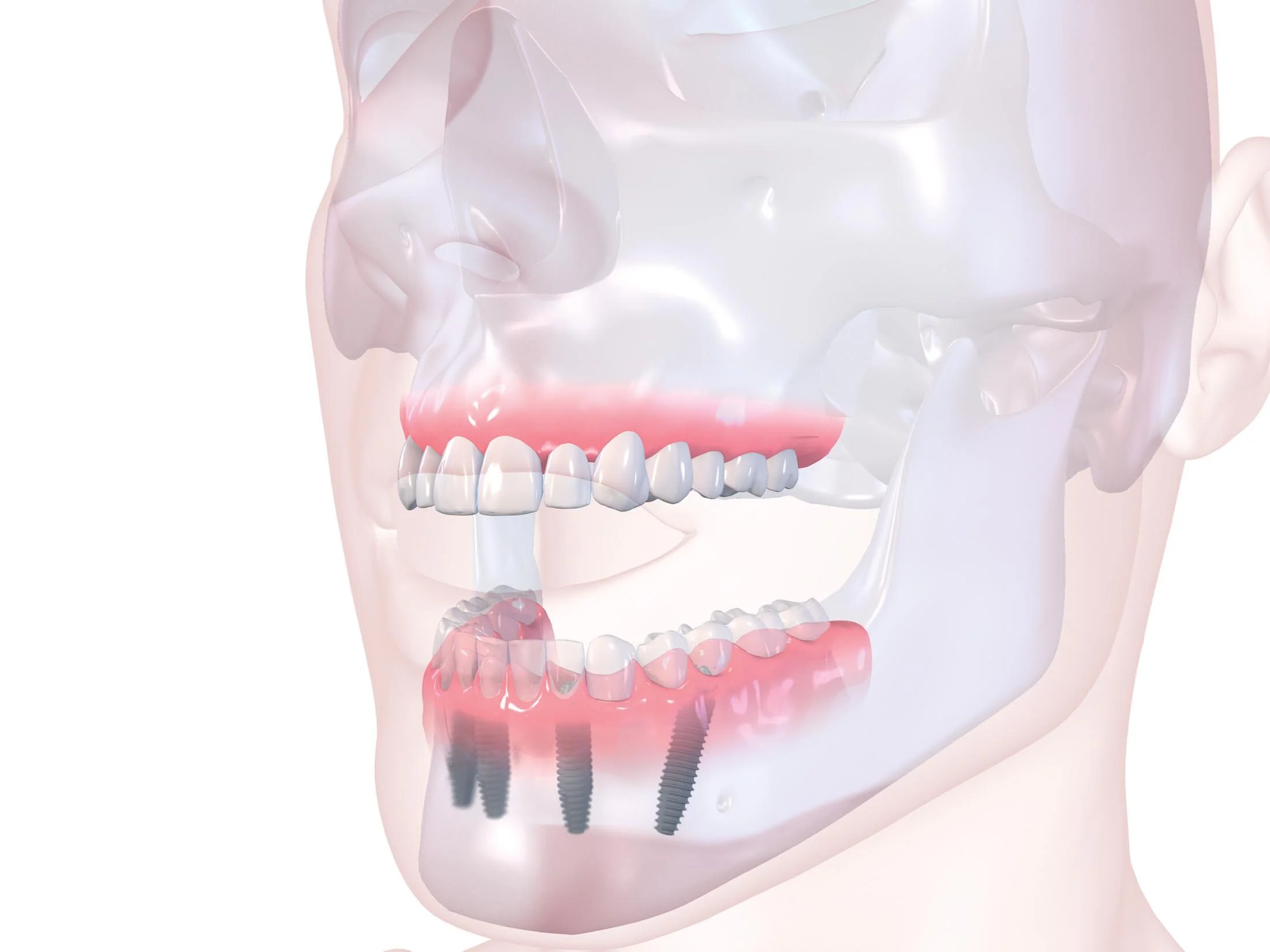 render of lower jaw teeth implants