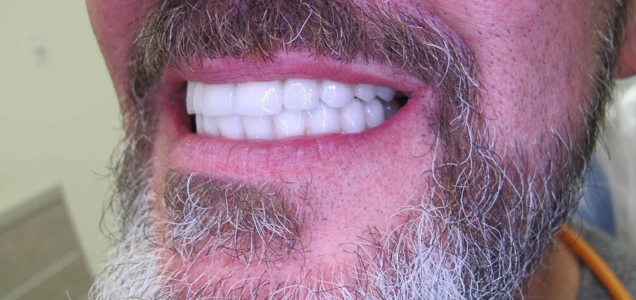 man's teeth after dental implants