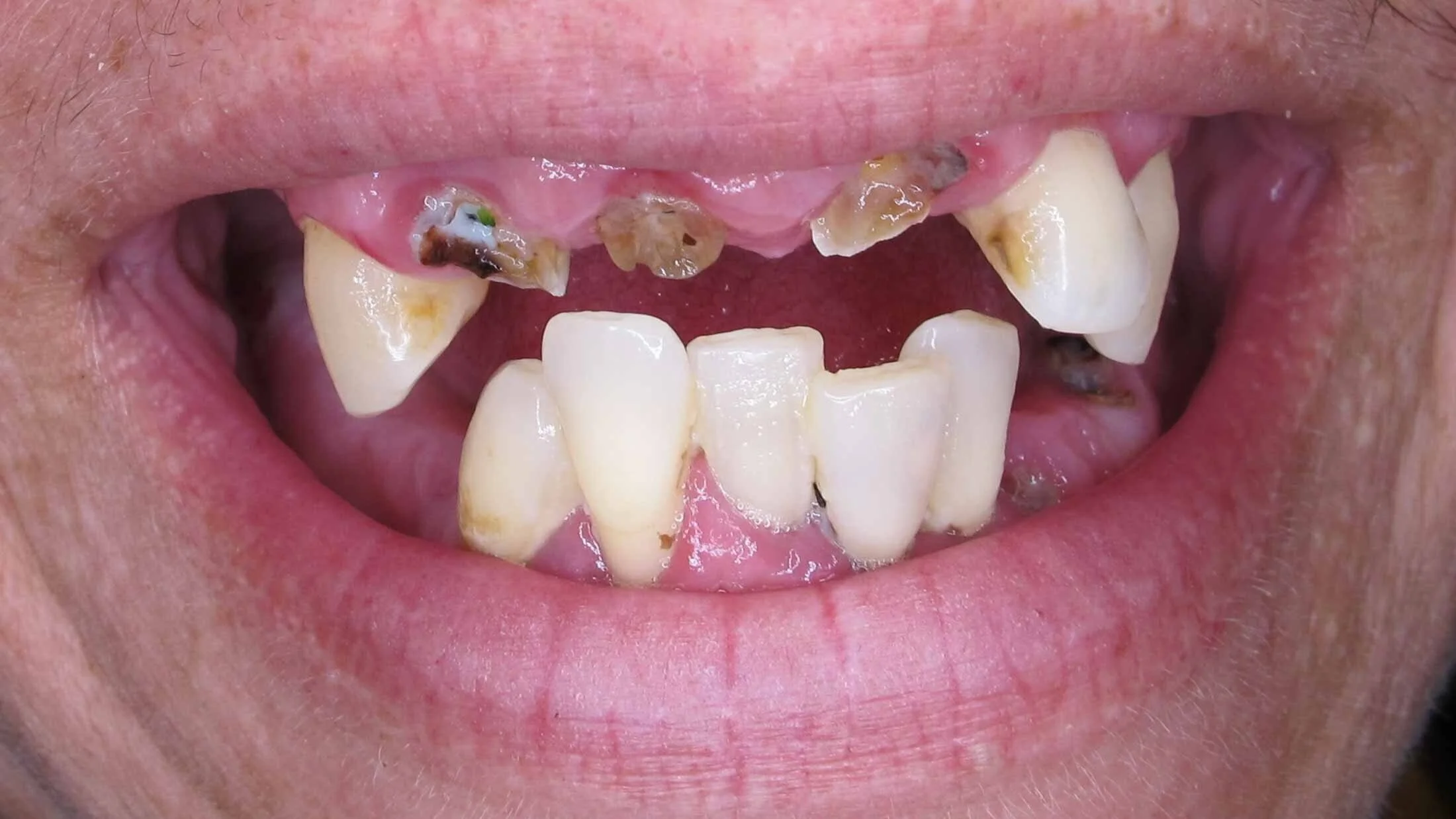 woman's rotten and missing teeth