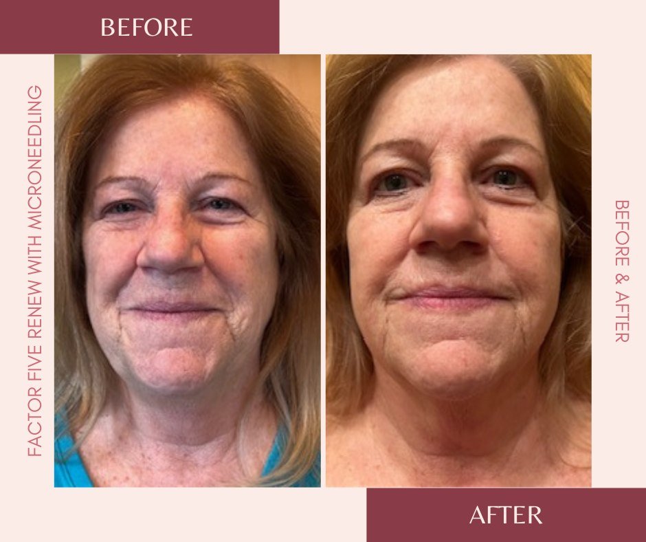 Check out these amazing results from our Factor Five Renew Peel with microneedling! Smoothed fine lines, tightened and lifted her skin. Truly amazing results with no down time! This is the  best alternative to invasive procedures. Great packages avai