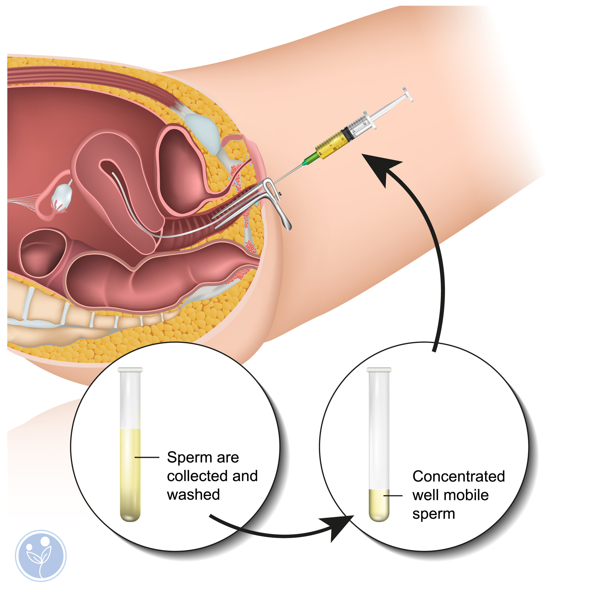 sperm bank home insemination