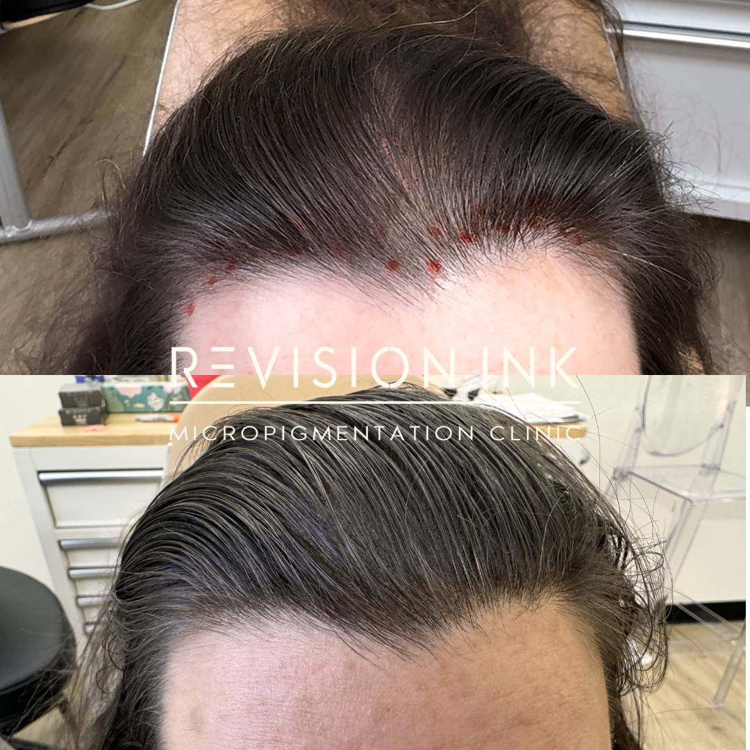 scalp b&a.png