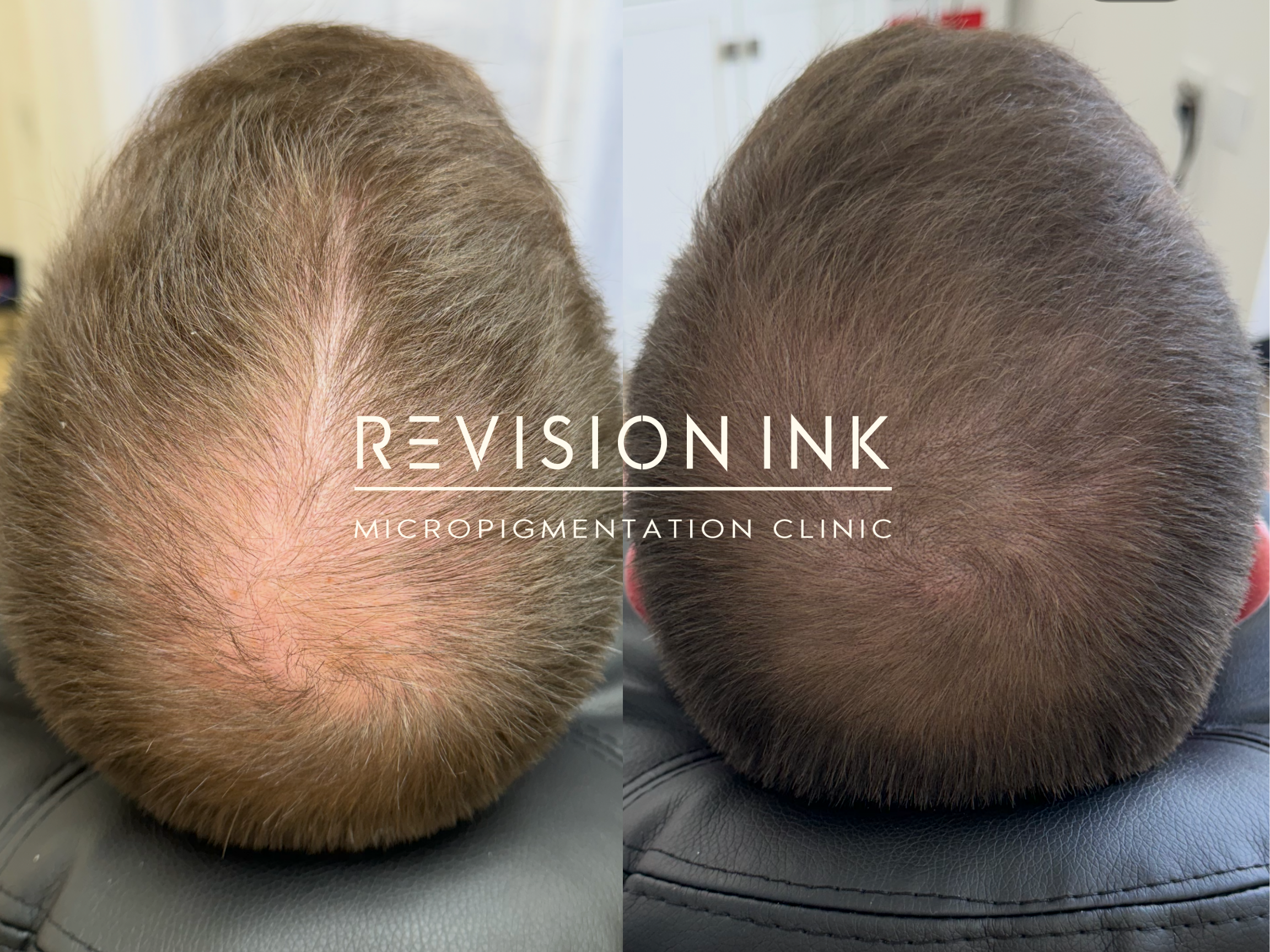 scalp b&a (1).png