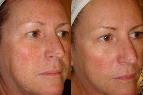 DermaSweep_Before_and_After_Pigmentation_1.jpg