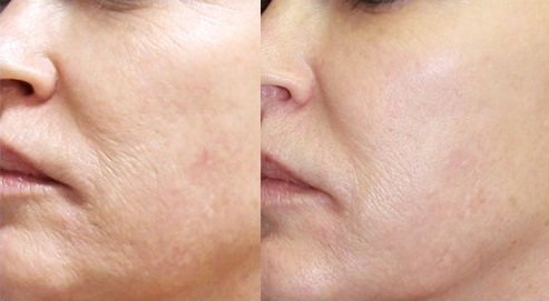 DermaSweep_Before_and_After_Tone-Texture_3.jpg