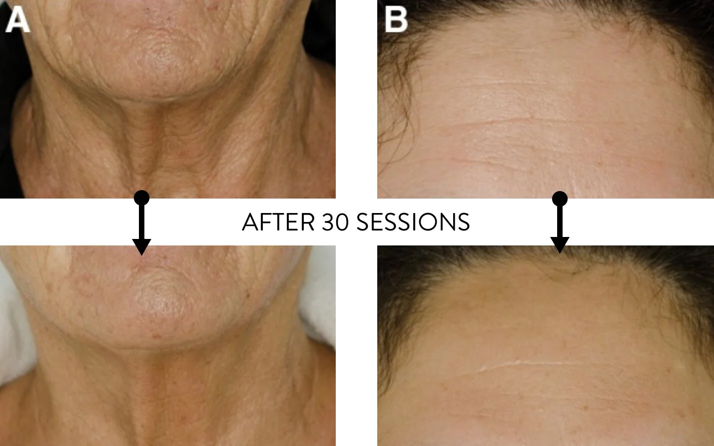 Boost Collagen With Red Light Therapy Radiance Bar