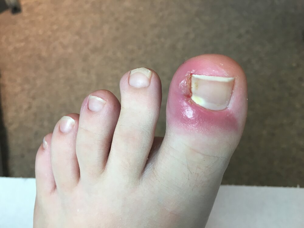 What is an ingrown toenail?: Gentle Foot Care Clinic: Podiatrists