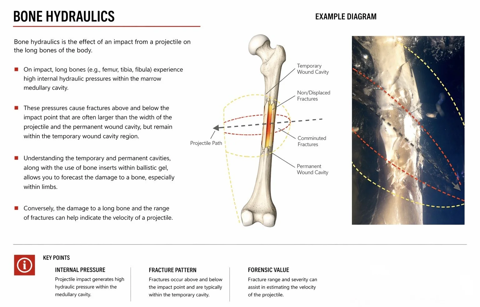 Diagram of a femur bone showing different types of fractures caused by impact, including temporary wound cavity, non-displaced fractures, comminuted fractures, and permanent wound cavity, with an example photo of a fractured femur.