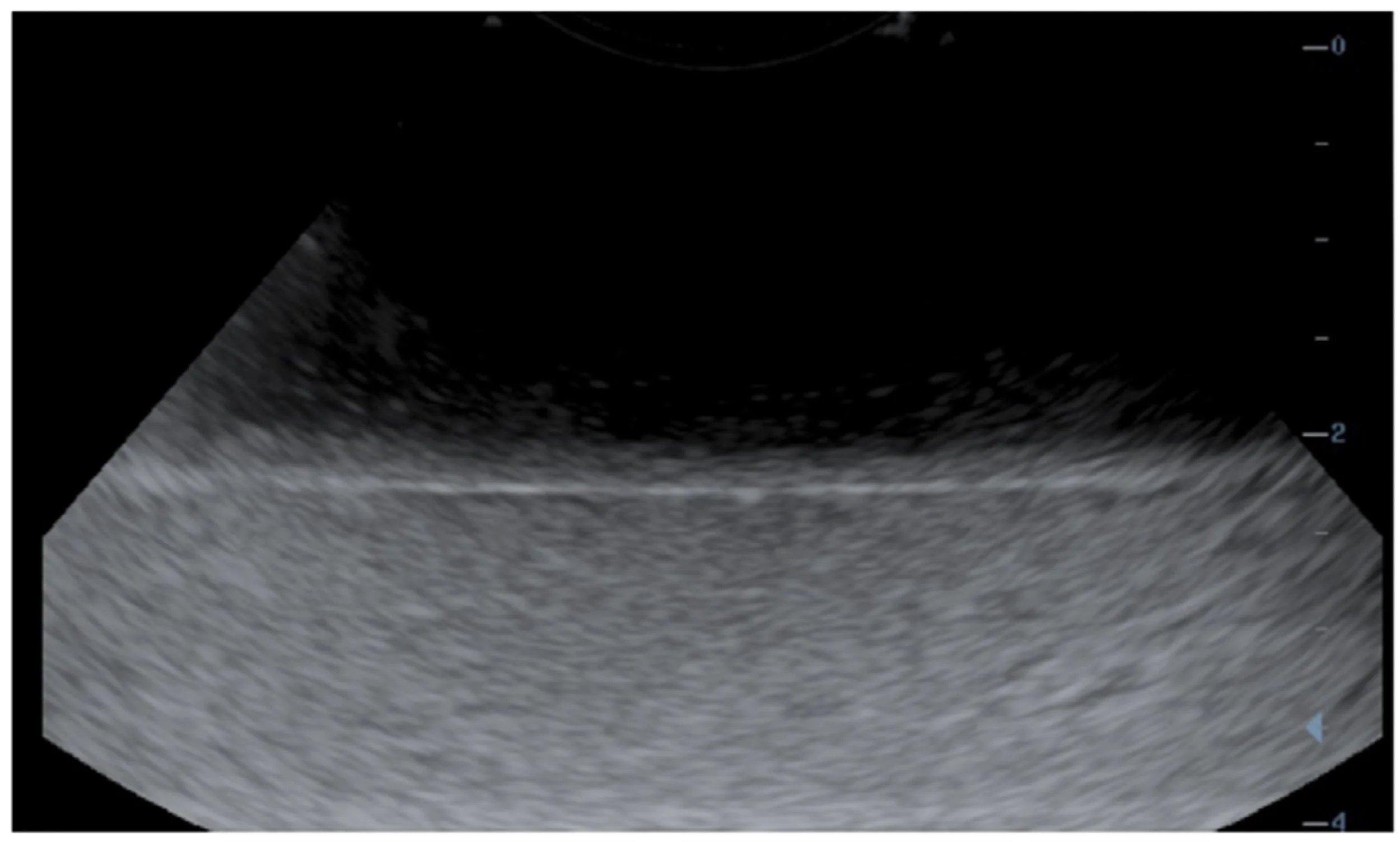 Ultrasound image of a ballistic gel phantom showing a Liver Parenchyma scan