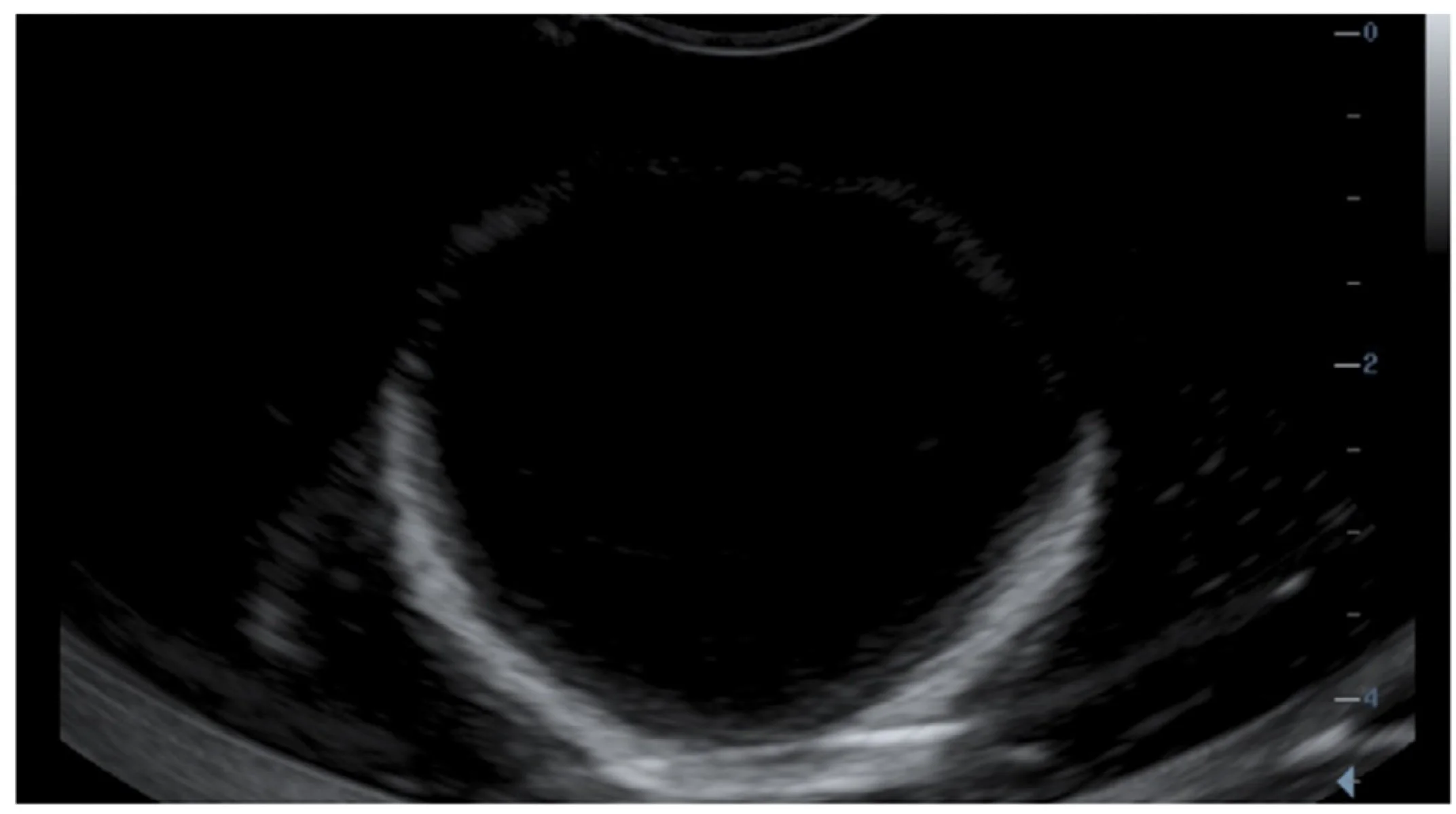 Ultrasound image of a ballistic gel phantom showing a Bladder scan.