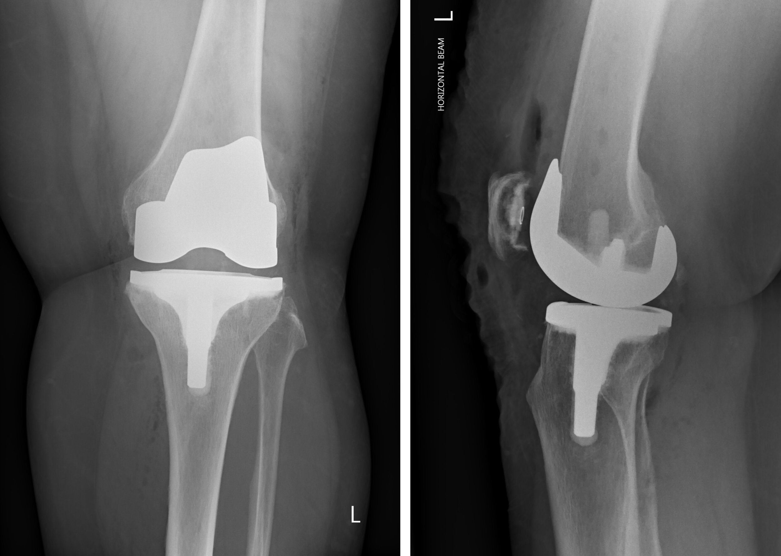 Speed up your knee replacement surgery