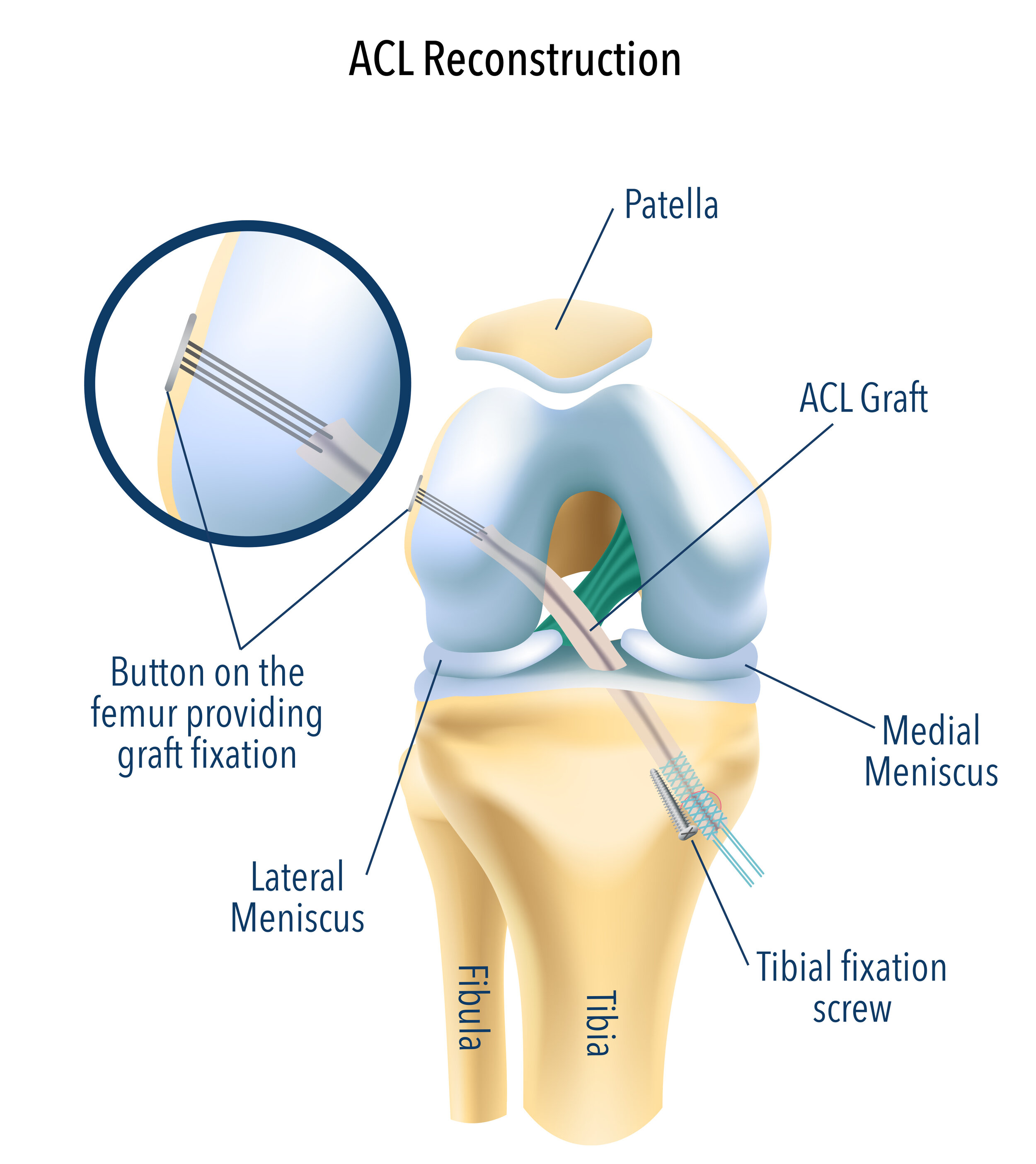 acl reconstruction