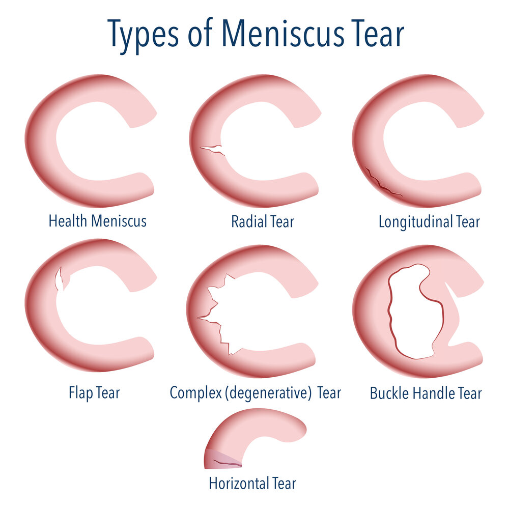 medial meniscus tear