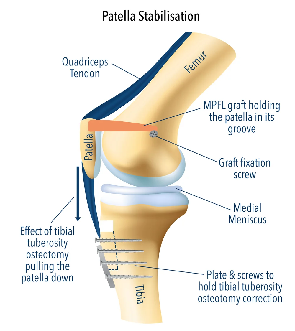 Patellar Development Patella Stabilization Surgery | MPFL Reconstruction Surgery