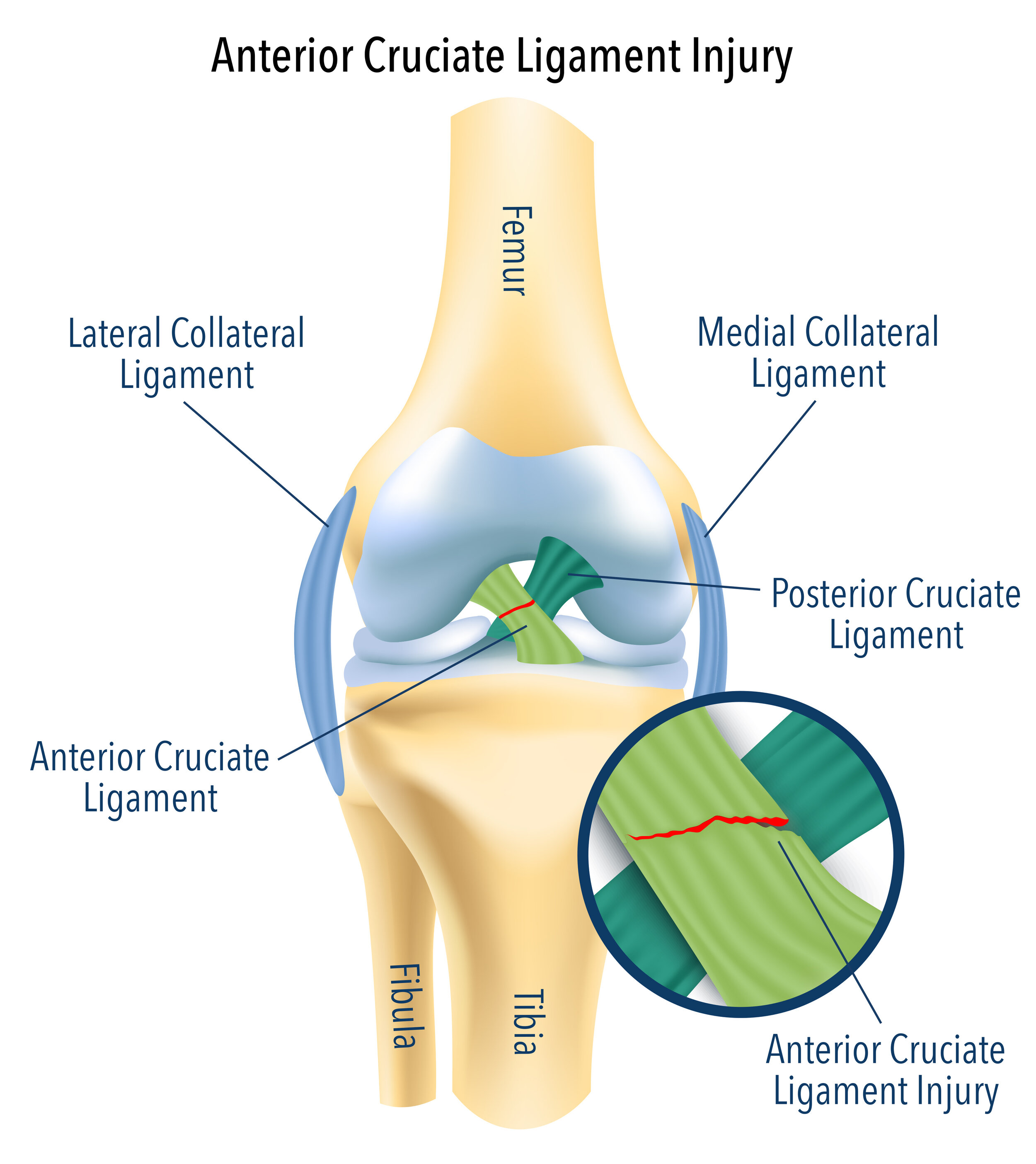 Knee Ligament Injury, Cause and Recovery