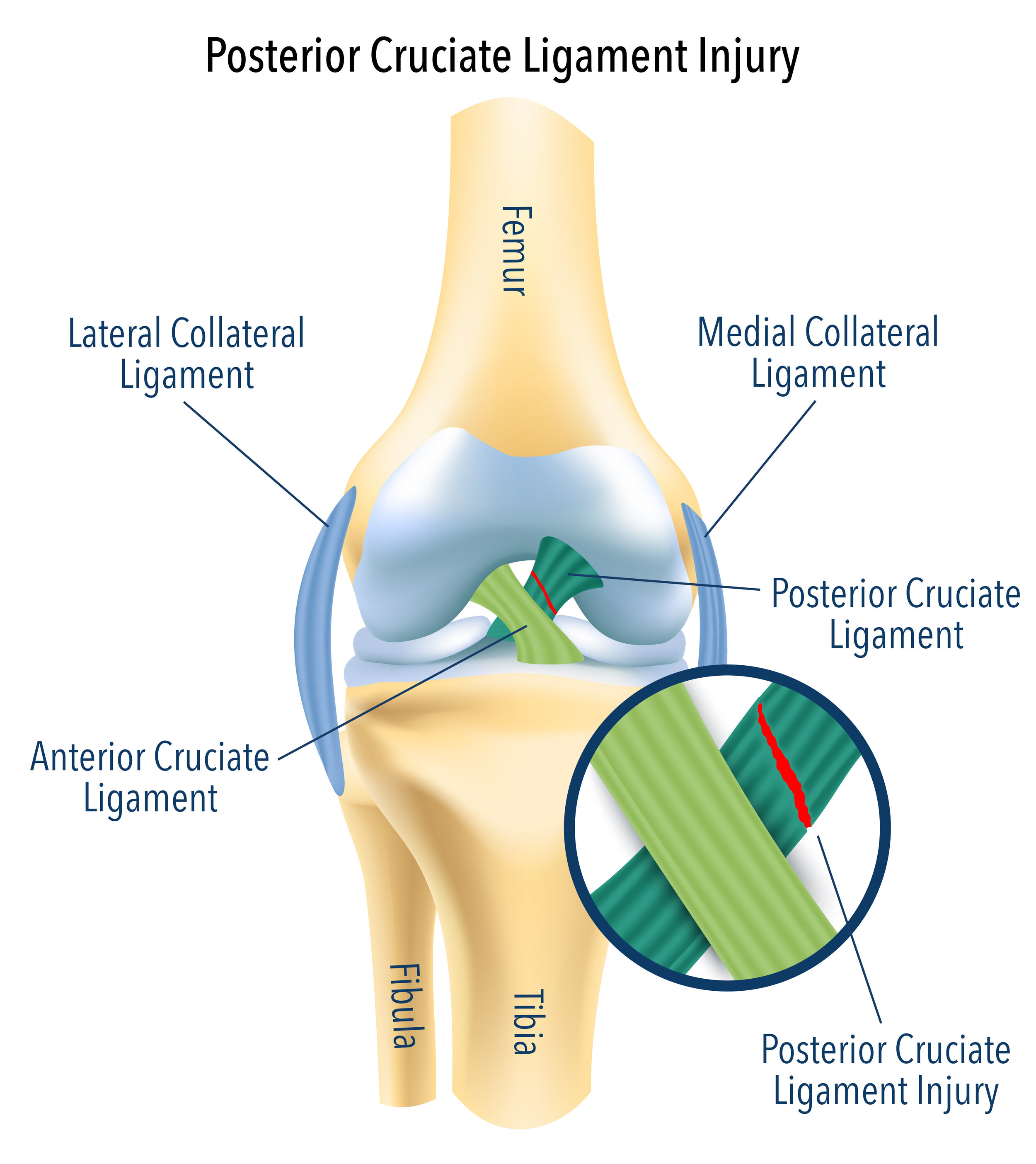 Posterior Cruciate Ligaments Injuries (PCL)