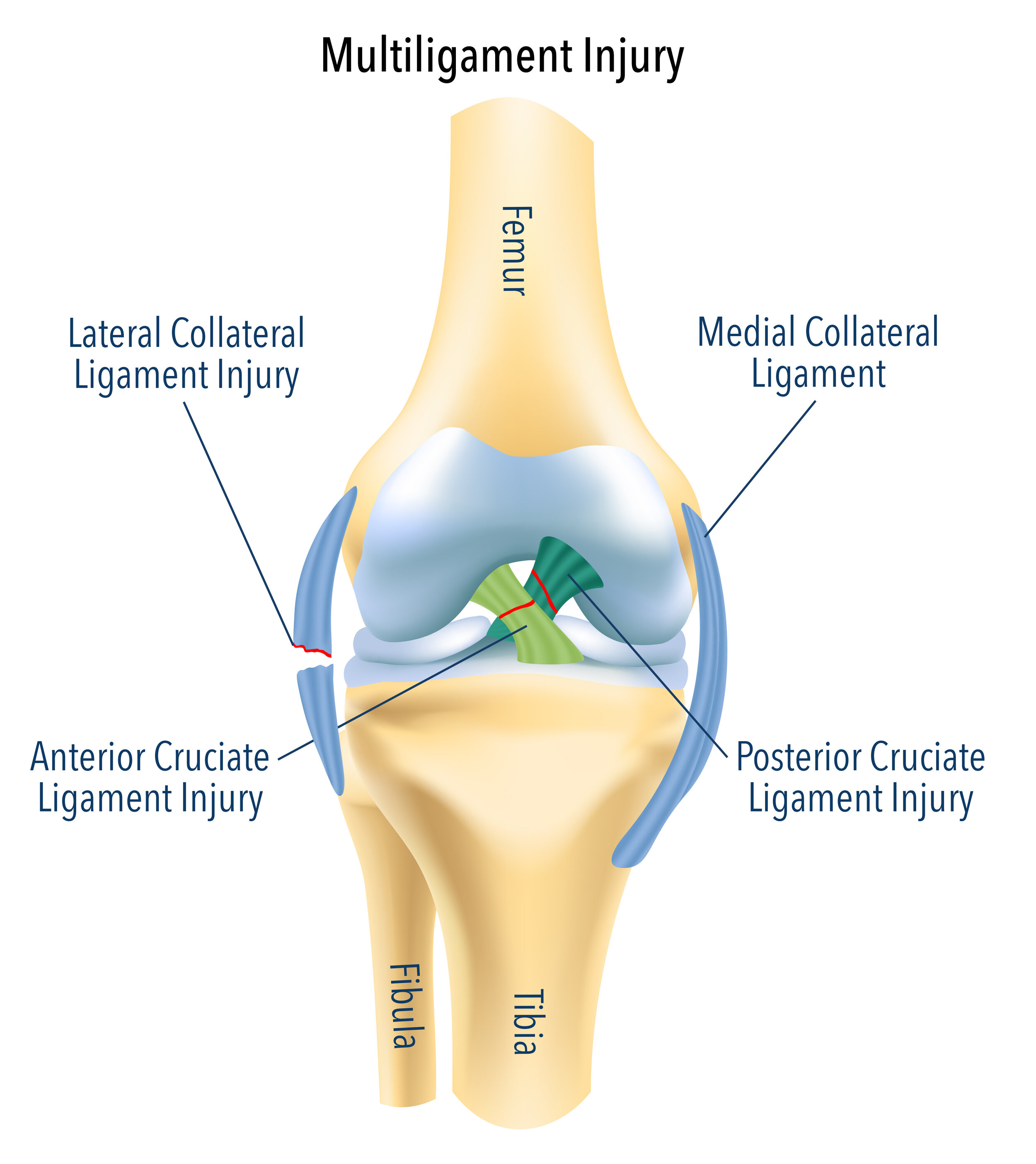 MCL Reconstruction, Medial Collateral Ligament Surgery
