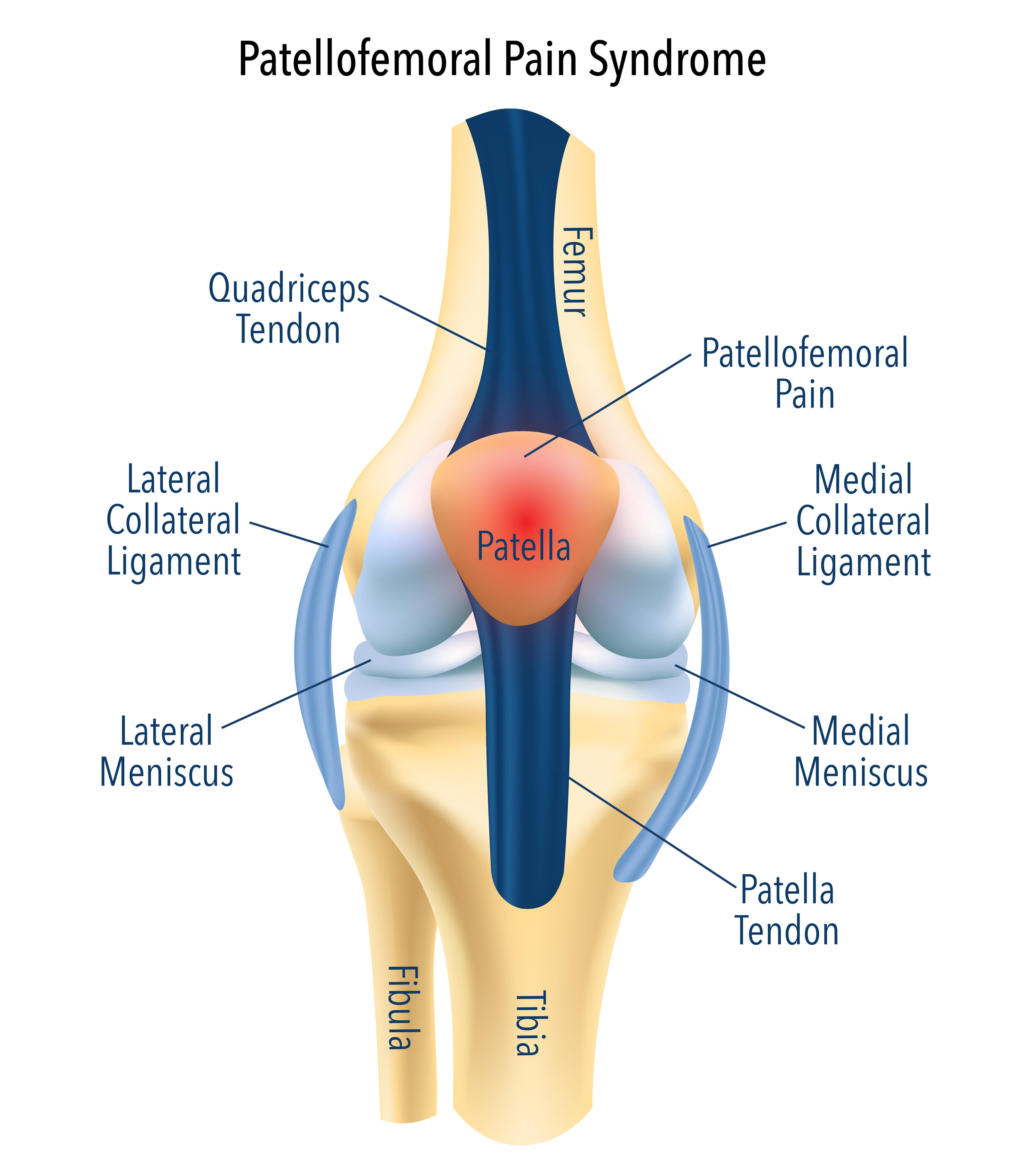 Patellofemoral Pain Syndrome