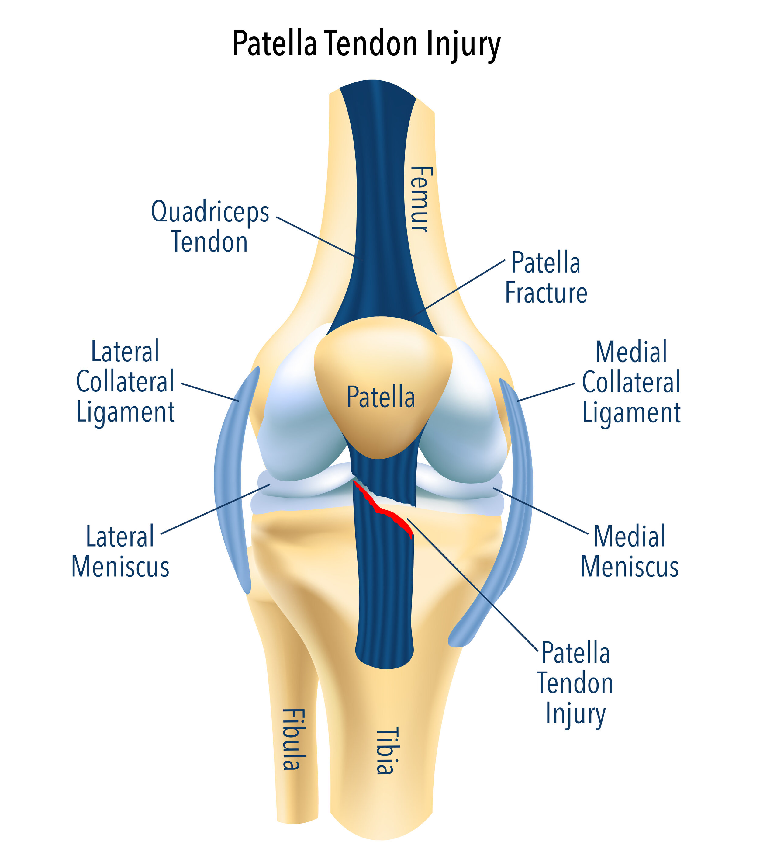 https://images.squarespace-cdn.com/content/v1/5e375d0ae354fa0b5ae4e8fd/1585975431082-GWAZDM2ECIS31RXHIWN9/Patella+Tendon+Injury+knee+condition.jpg