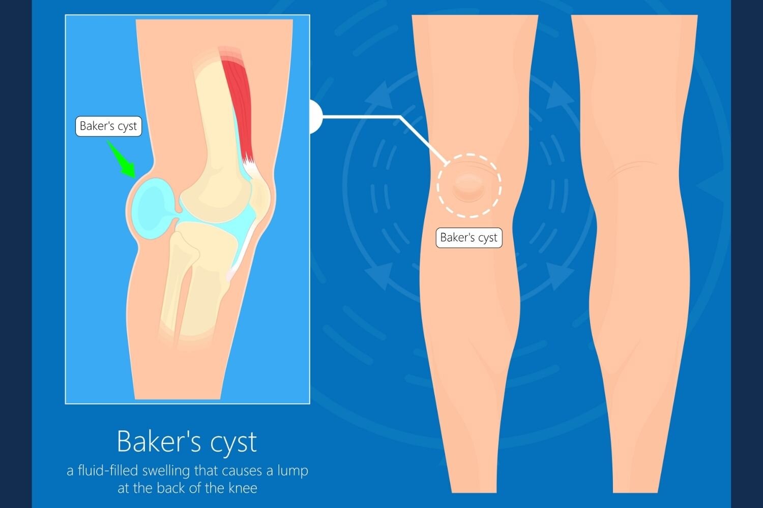 osteoarthritis knee lump