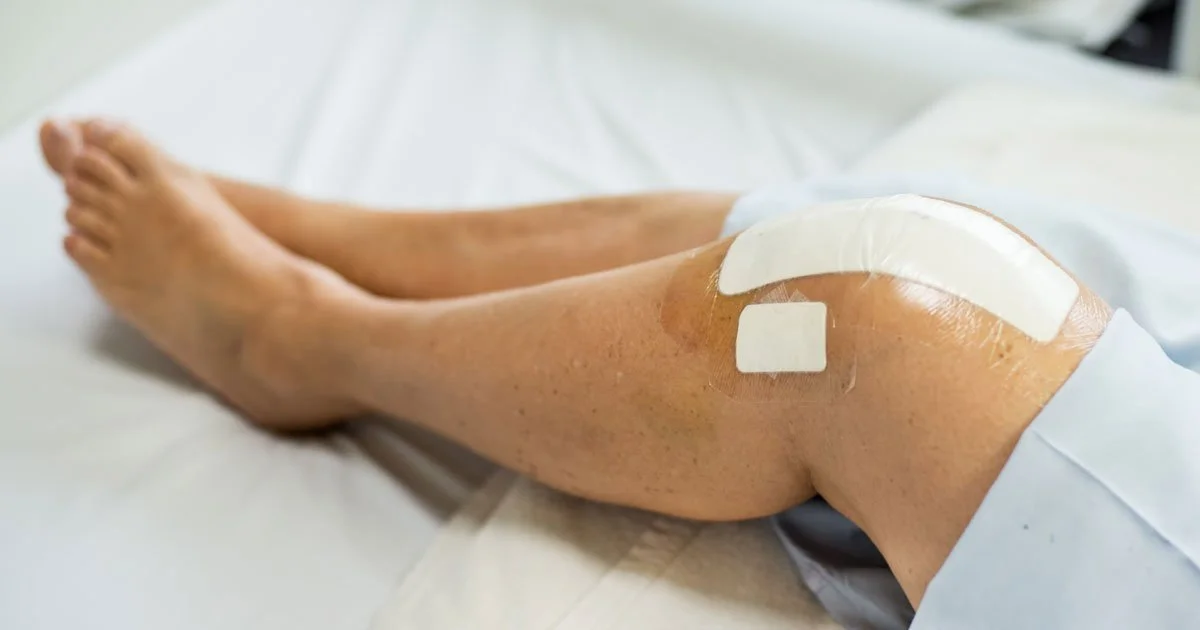 Recovery Timeline After Knee Surgery: Insights From an Experienced Knee Surgeon