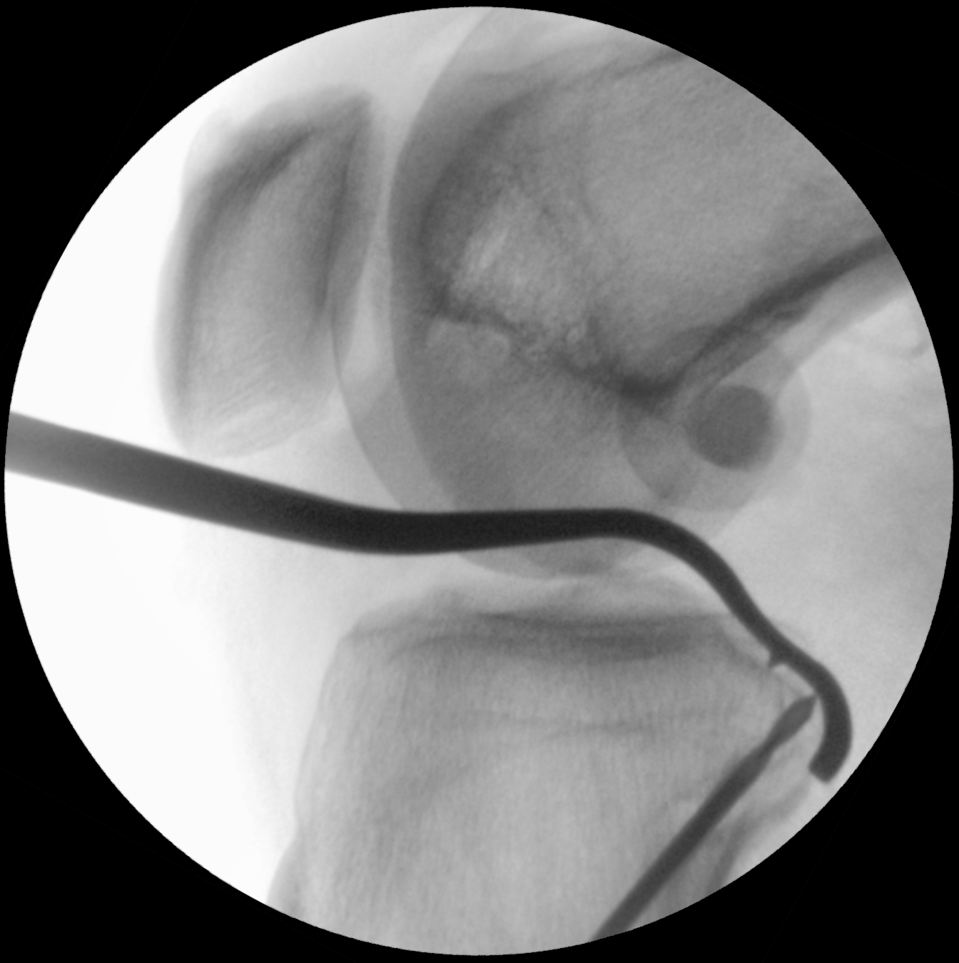 pcl-reconstruction-posterior-cruciate-ligament