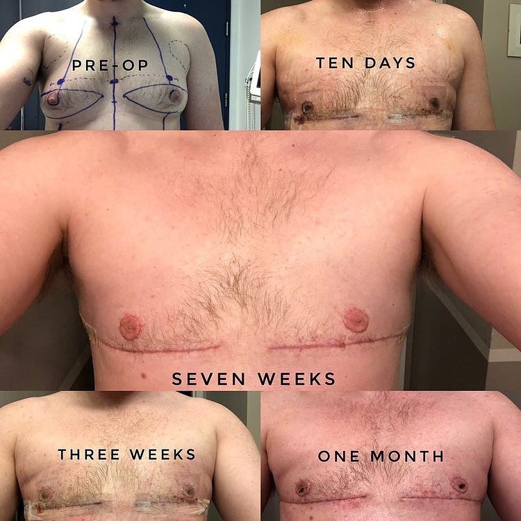 A patient was generous to share some photos of their top surgery journey, and early results. #ftm #femaletomale #ftmtransition #transhealth #femaletomaletransgender #femaletomaletrans #topsurgery #transmenofig #ftmpride #ftmtopsurgery #transguysofig 