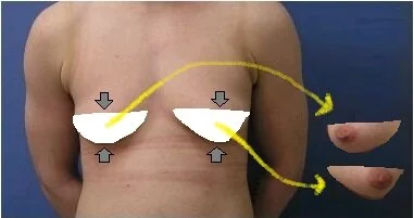Double Incision Vs. Keyhole — VancouverTopSurgery.com