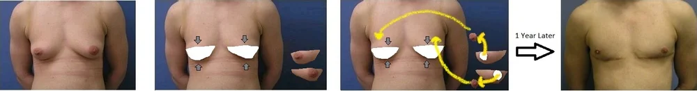 Double Incision Vs. Keyhole — VancouverTopSurgery.com