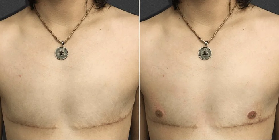 Double Incision Vs. Keyhole — VancouverTopSurgery.com