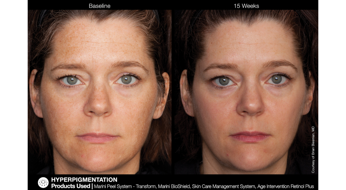 jan marini transform peel