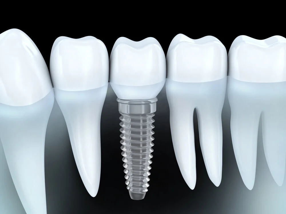Dental-Implants.jpg