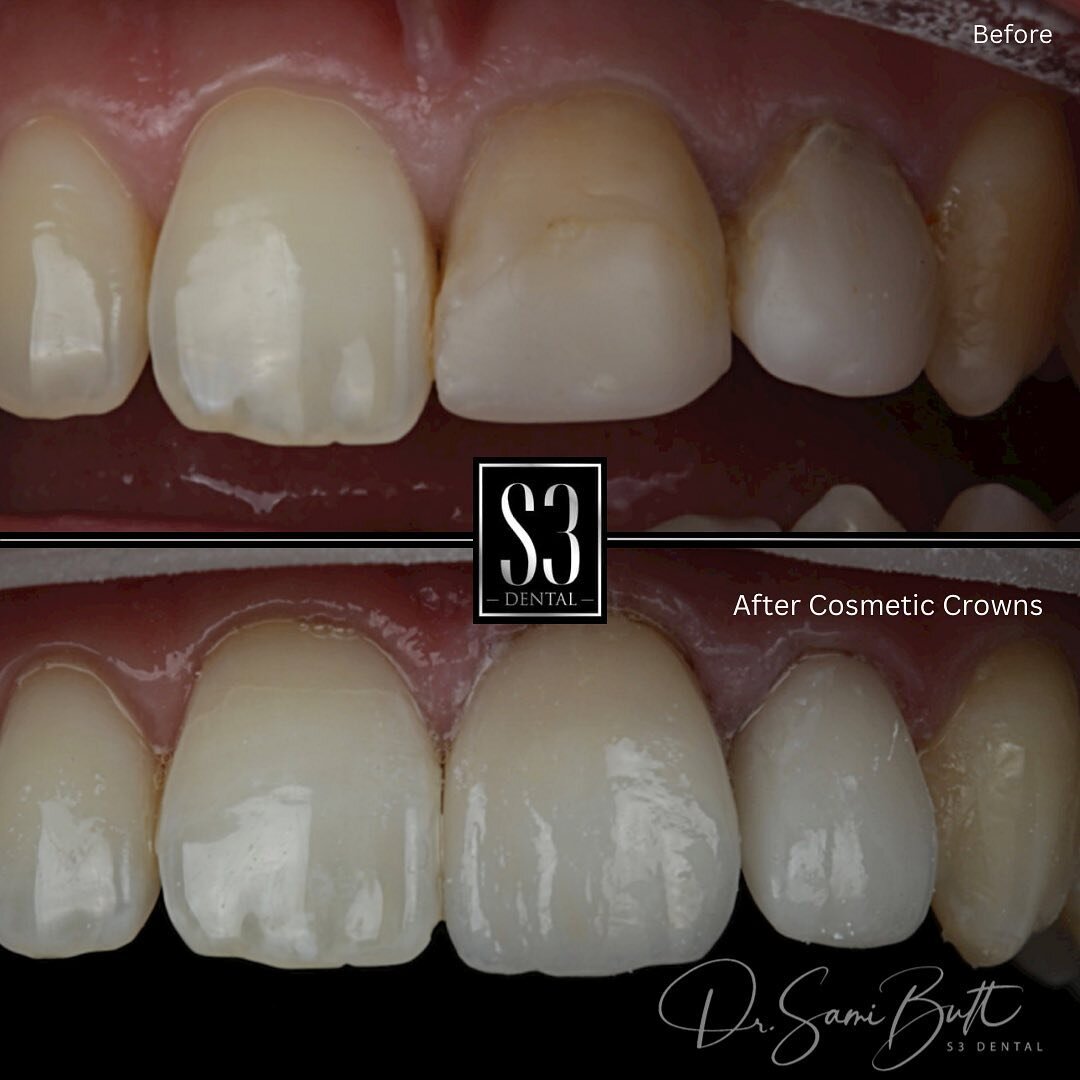 A Smile Makeover Using Cosmetic Crowns.

Dentist @dr.samibutt 

📍Haywards Heath, Mid Sussex 

Finance options available.

📱Dm for more info. 

#s3dentalhh #haywardsheath #cuckfield #burgesshill #horsham #hassocks #hurstpeirpoint #crawley #briggtona