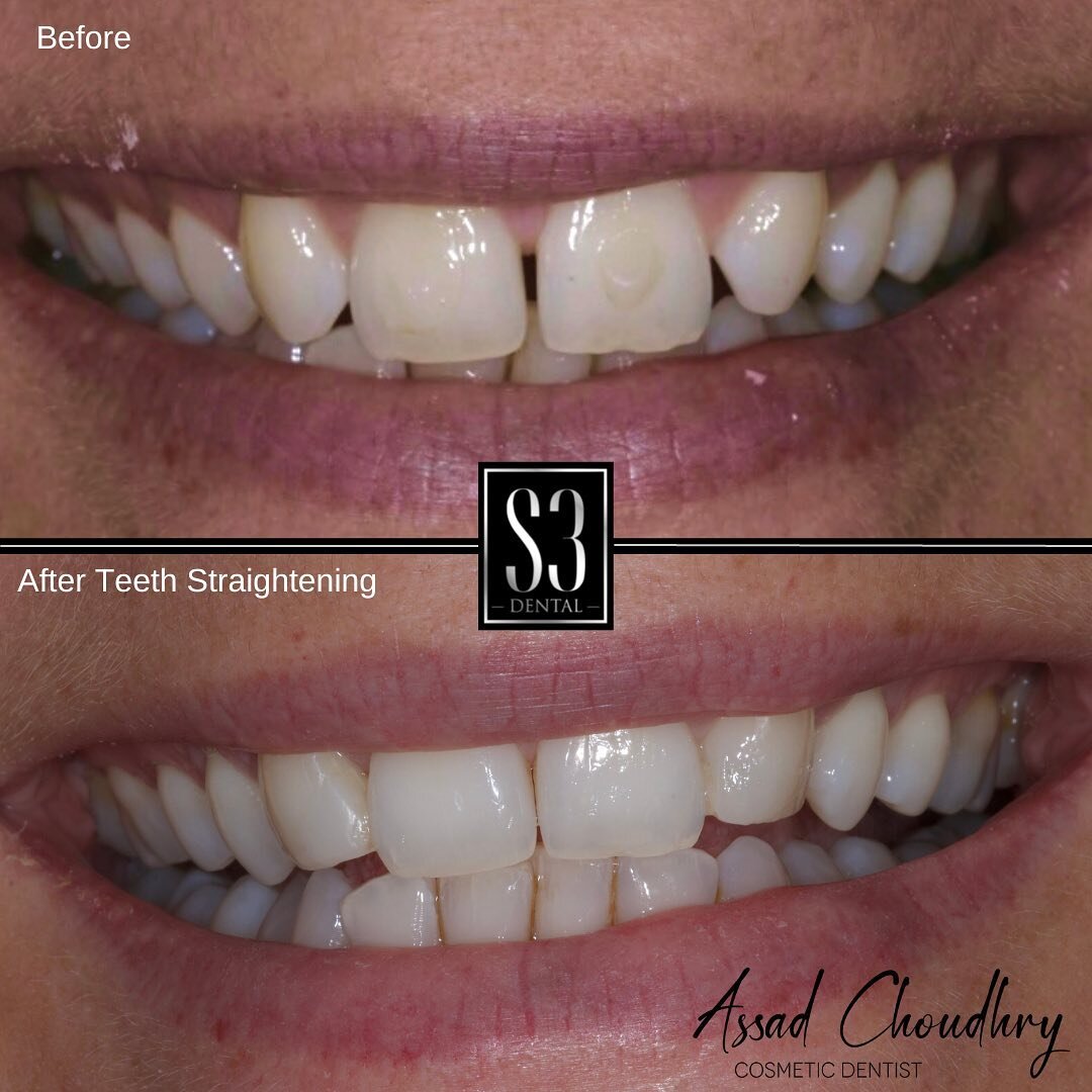 ClearCorrect is a clear aligner system used to straighten teeth. It can be used to correct misaligned teeth and to improve the aesthetics of the smile. ClearCorrect consists of a series of removable, custom-made aligners that work to slowly and gentl