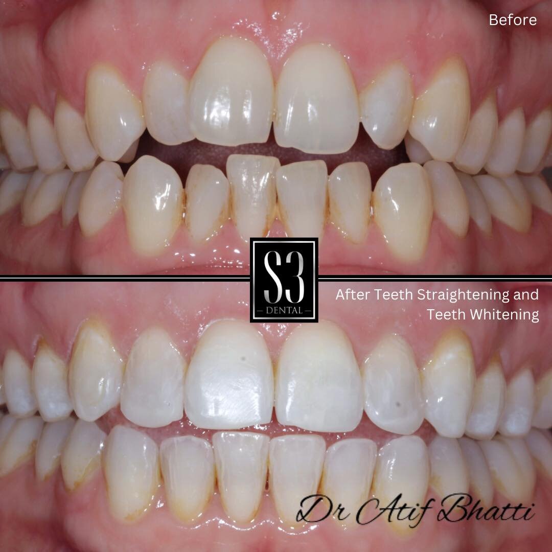 The Perfect Combo!

Teeth straightening combined with teeth whitening make for a great combo for achieving a beautiful and healthy smile. 

Teeth Straightening - @clearcorrectuk

Teeth Whitening - @boutiquewhitening

Dentist - Dr Atif Bhatti 

Dm us 