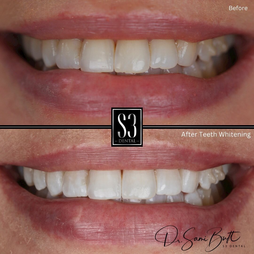 Teeth whitening lightens teeth and helps to remove stains and discolouration from the teeth, resulting in a brighter more youthful smile.

Dentist @dr.samibutt 

📍 Haywards Heath, Mid Sussex

#s3dentalhh #haywardsheath #hassocks #burgesshill #lindfi