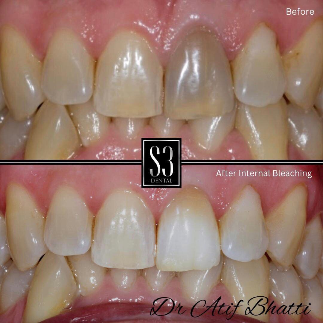 Aging, certain medications, or trauma can cause a tooth to discolour. Internal teeth whitening is a procedure used to whiten teeth from the inside out. During the procedure, whitening gel is applied to the inside of the tooth, which helps to brighten