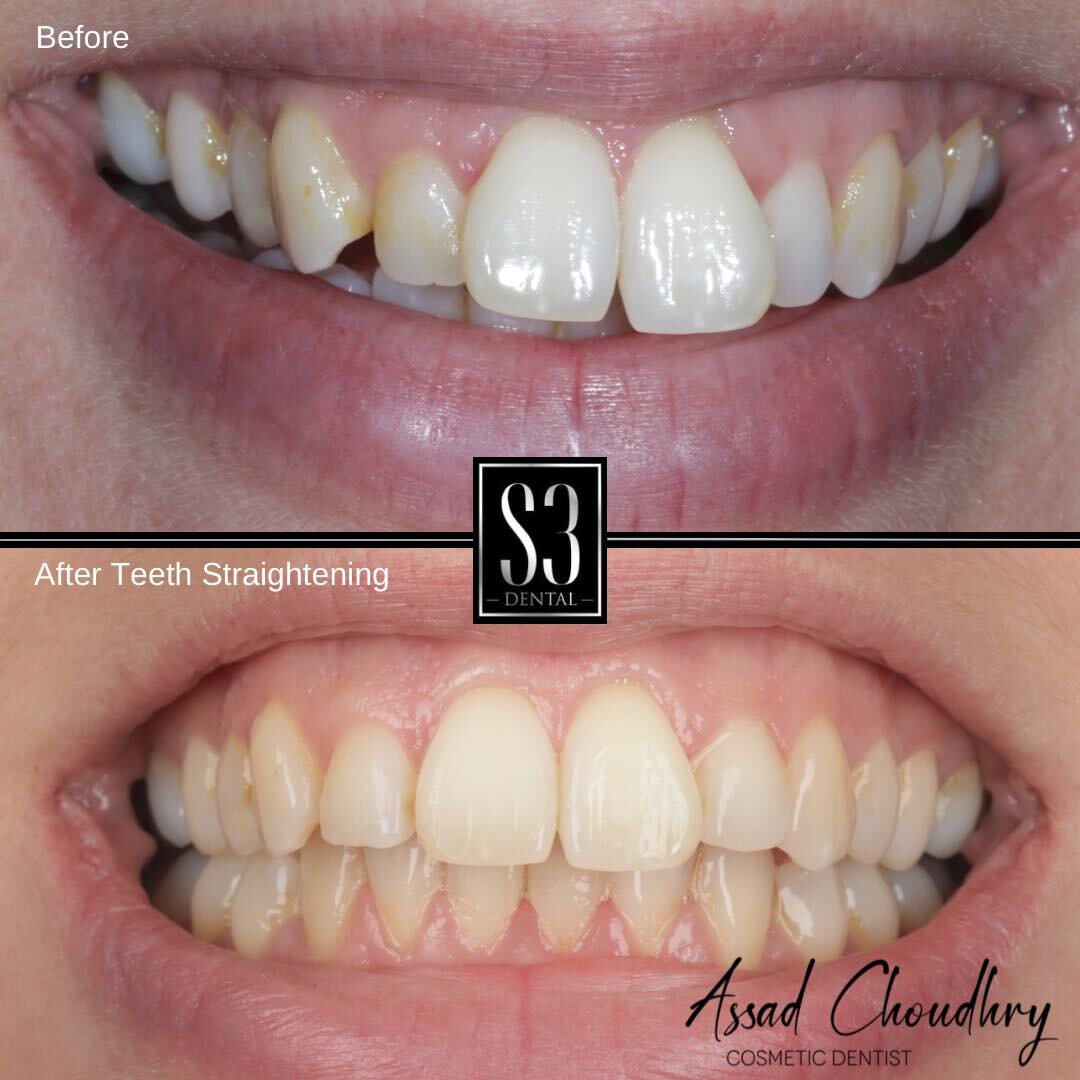Straight teeth make a beautiful smile 😁 Check out these amazing result.

Treatment - ClearCorrect Clear Aligners

Dentist - Dr Assad Choudhry

📍Haywards Heath, Mid Sussex

Dm us for more info 📱

#s3dentalhh #haywardsheath #cuckfield #burgesshill #