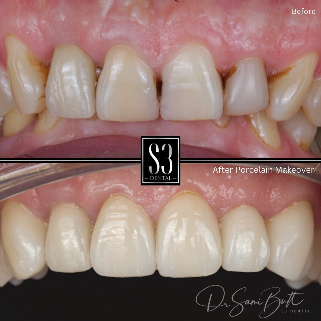 The goal of a smile makeover is to create a natural-looking and functional smile that our patients can be proud of. This can be done through a variety of cosmetic dental treatments such as porcelain restorations, orthodontics or teeth whitening. 

Tr