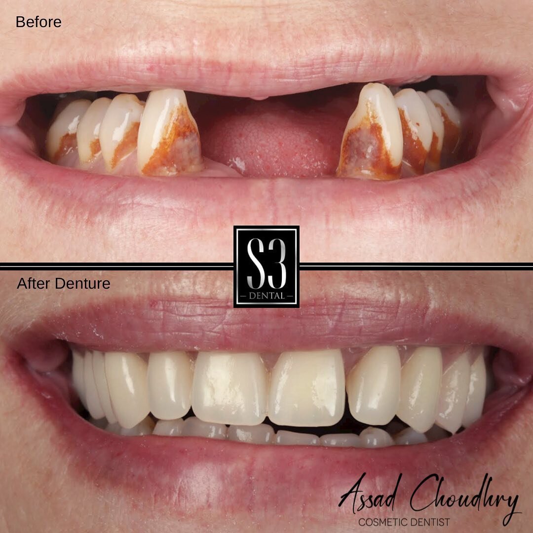 Benefits of replacing missing teeth with a denture.

1. Improves Appearance: Replacing missing teeth improves your smile and gives you a more youthful look.

2. Improves Speech: Missing teeth can make speaking properly difficult. 

3. Improves Eating