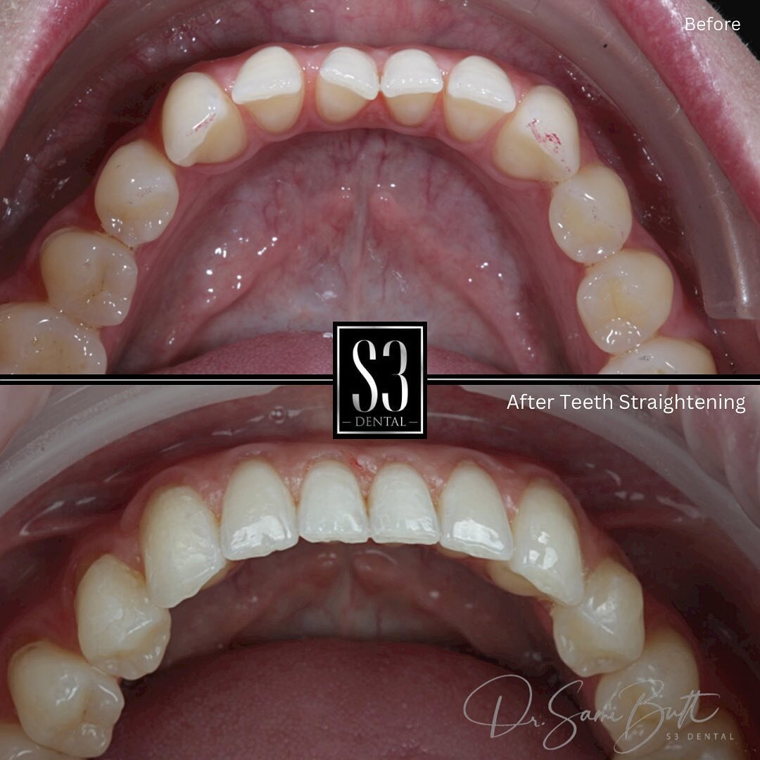 ClearCorrect is a clear aligner system that uses a series of custom-made aligners to straighten your teeth. These  aligners are worn for two weeks before moving on to the next in the series. ClearCorrect aligners are virtually invisible, so they are 