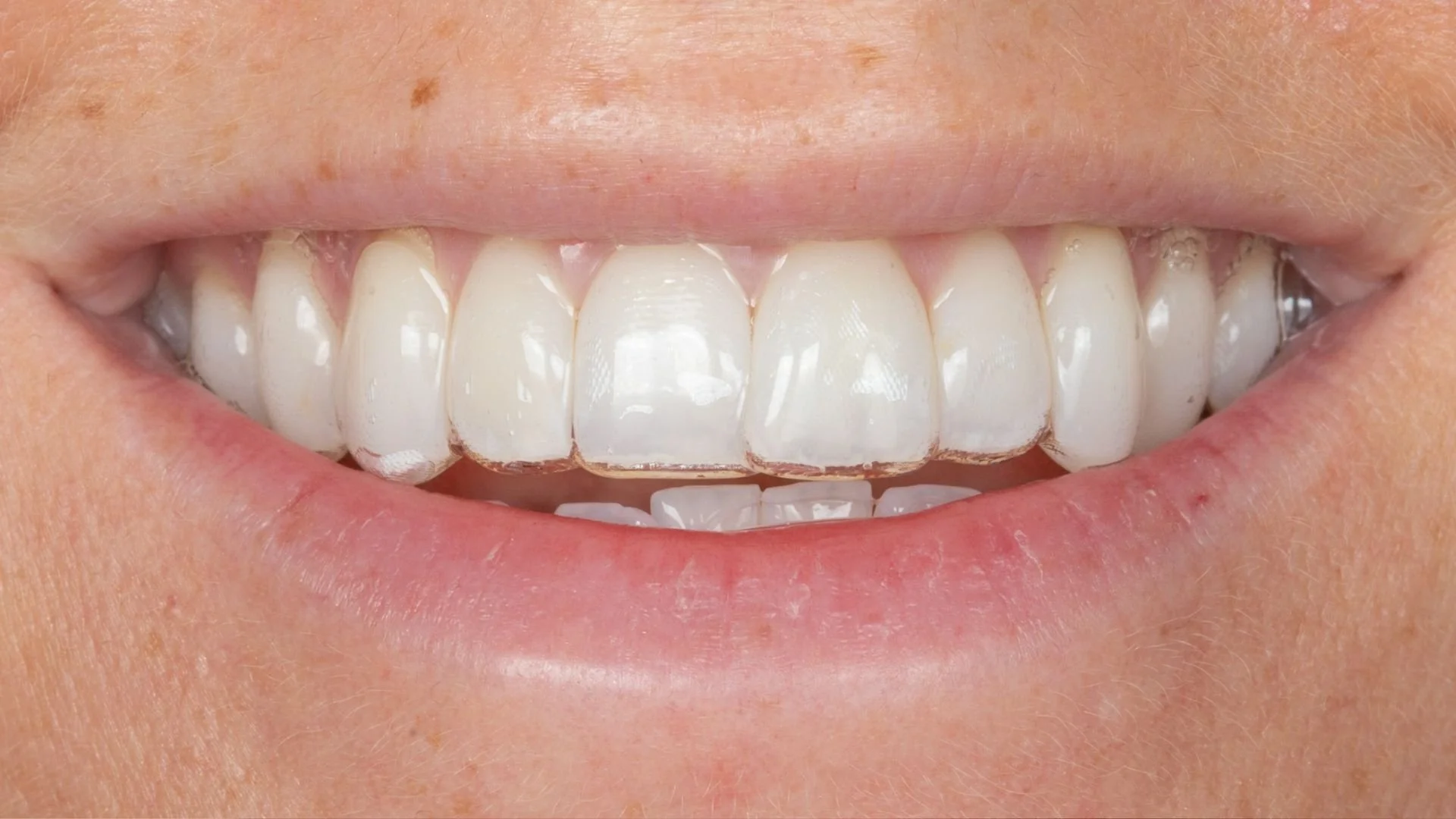 What is the cheapest way to fix crooked teeth?