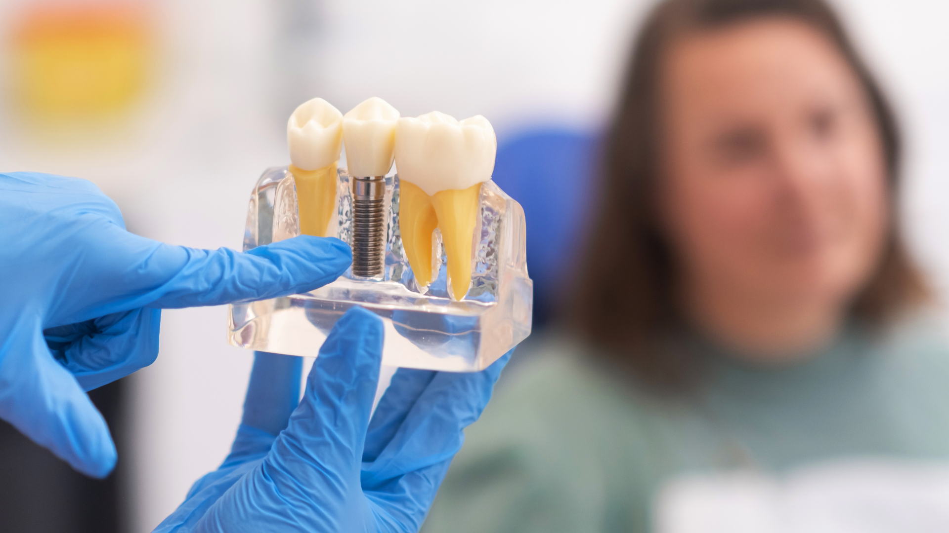 What are Dental Implants?
