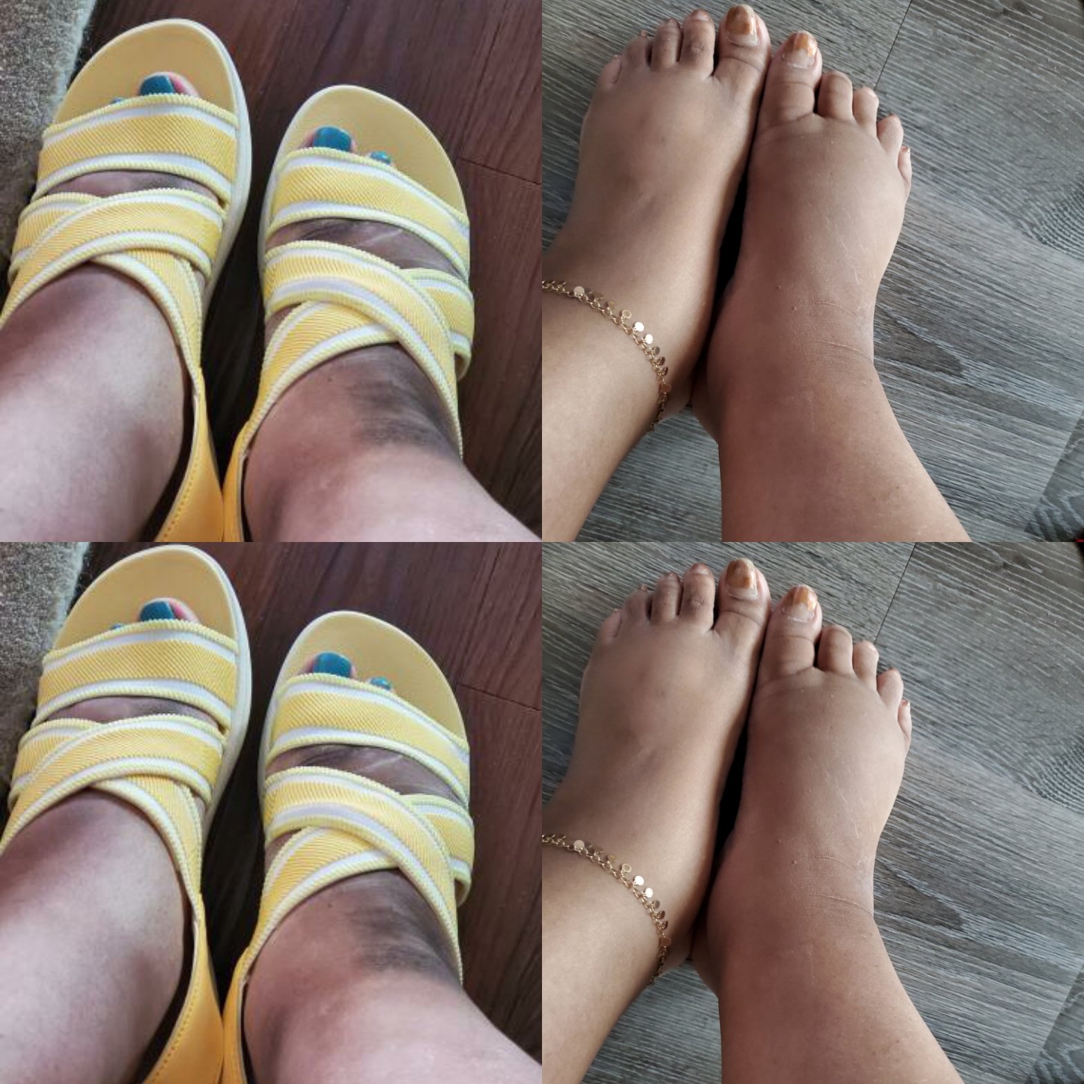 Diabetic Neuropathy