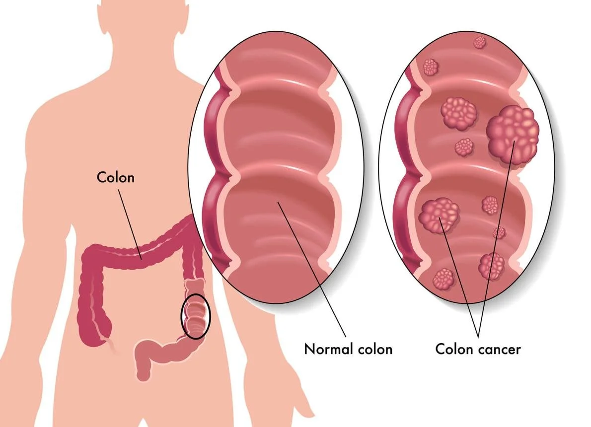 colon.jpeg