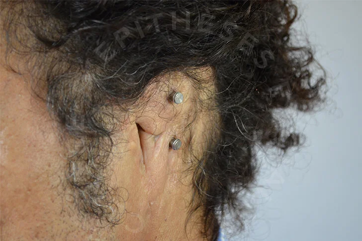 Auriculaire En Savoir Anaplastologie Auriculaire En Savoir Anaplastologie