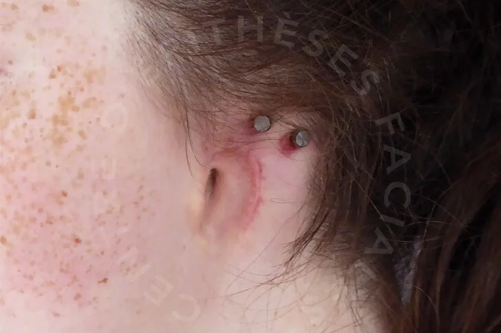 Auriculaire En Savoir Anaplastologie Auriculaire En Savoir Anaplastologie