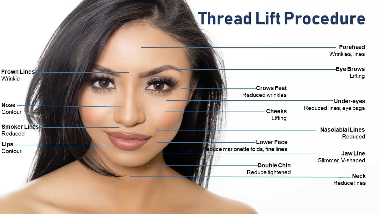 Лоб перевод. Beauty Lift v line thread логотип. Baby forehead процедура. Thread Lifting. Нити l Tread Lift.