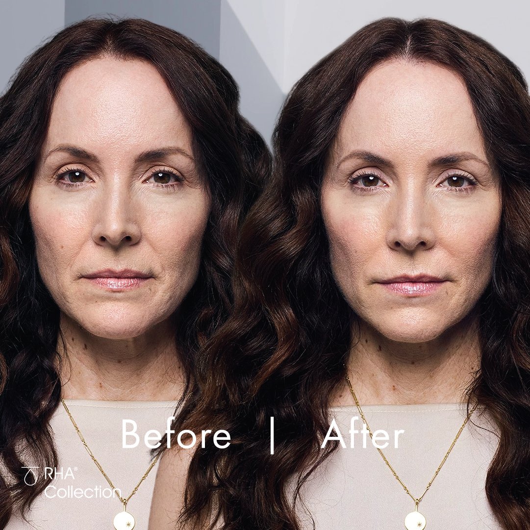 RHA Filler — Novel Skin Solutions